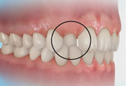 Perfect Smile Perfect Smile mal occlusion - Anterior Crossbite